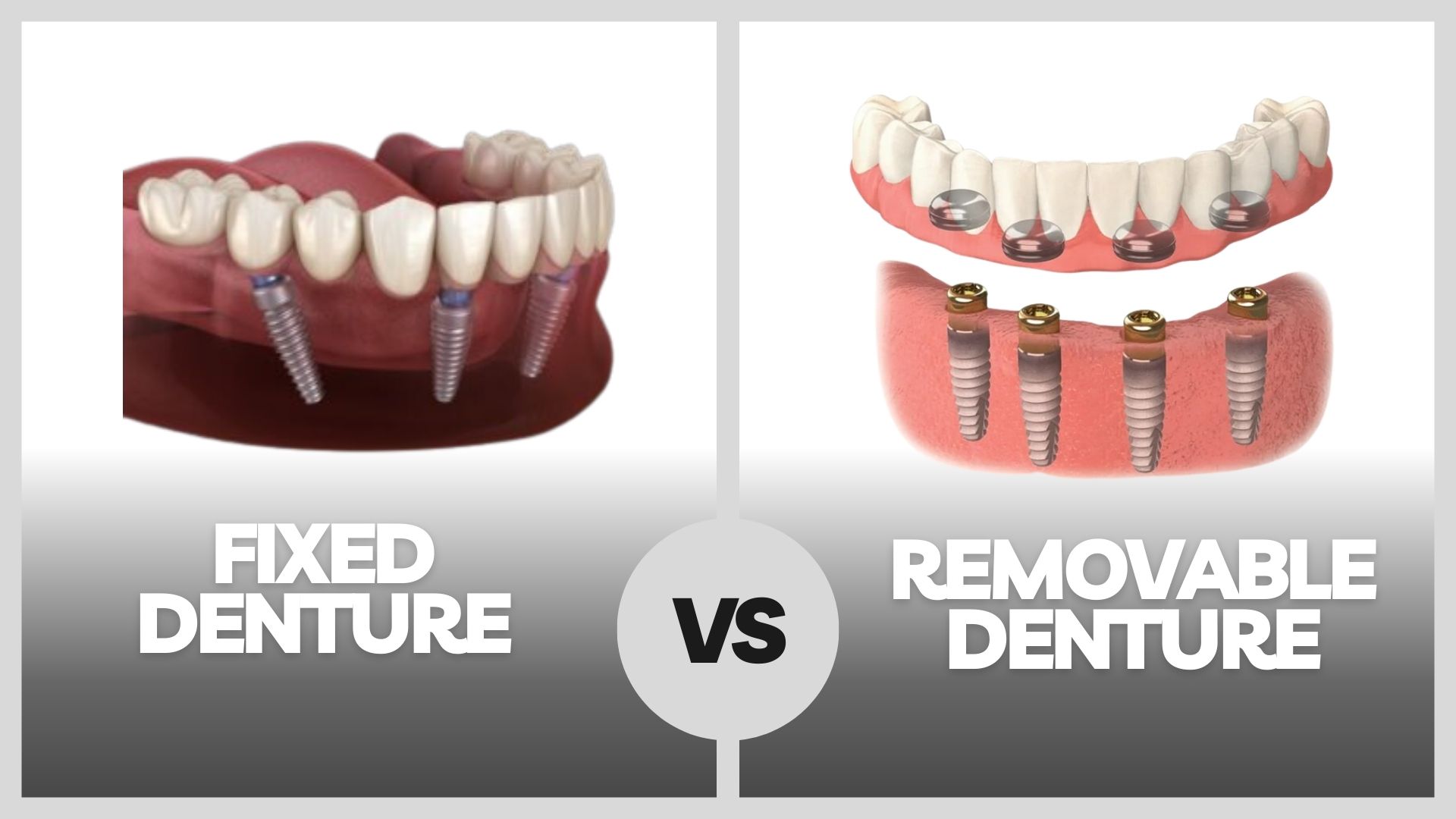Dental Services fixed-vs-removable-implant-denture