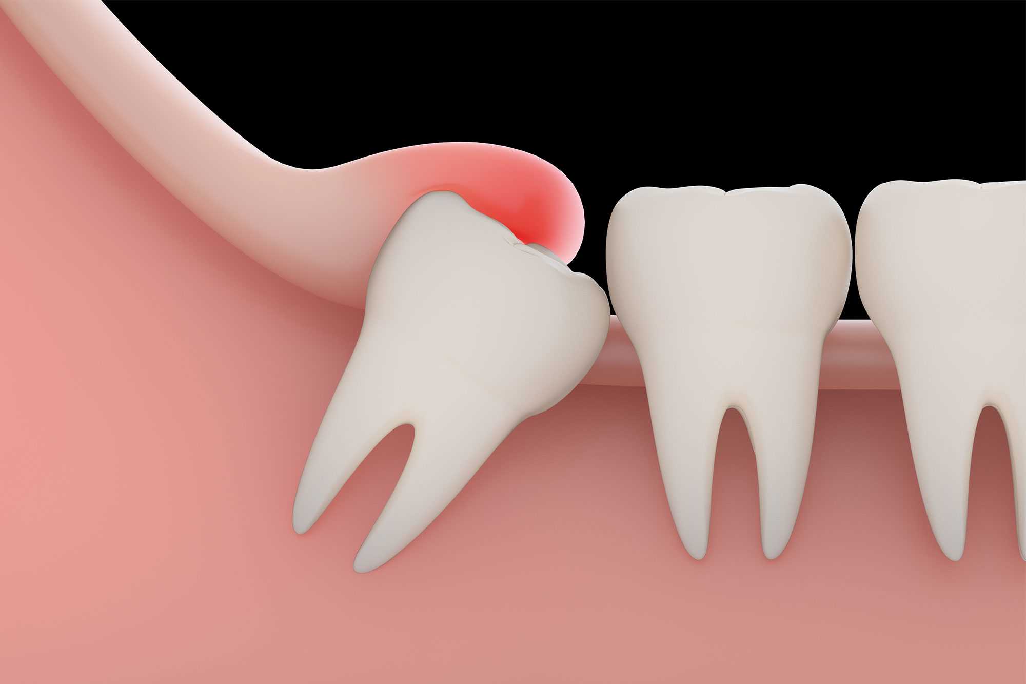 Tooth Extractions and Wisdom Tooth Removal Dental Services